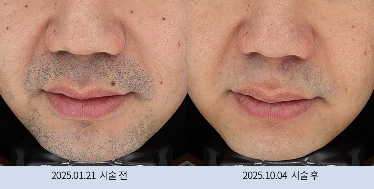 스노우의원 다산점 레이저 제모 전후